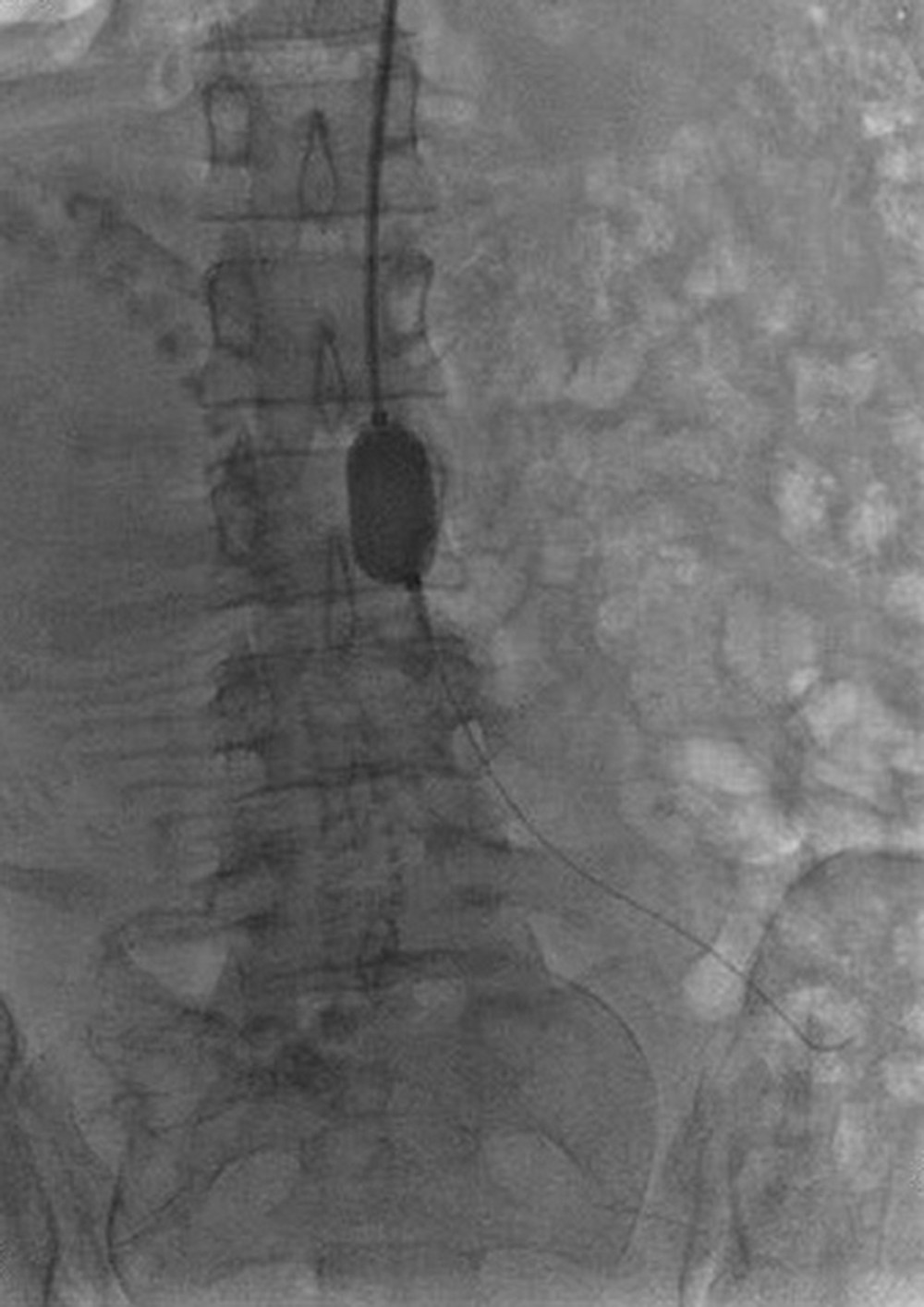 The image shows the filled balloon blocking the abdominal aorta.