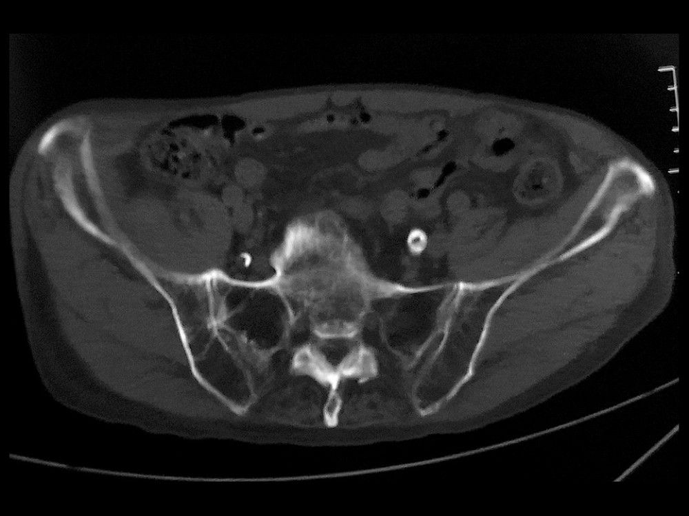 Transverse computed tomography (CT) scan of an 80-year-old woman with osteoporosis. There are obvious alar voids in both sacral alae, corresponding with a significant resorption of trabecular bone.