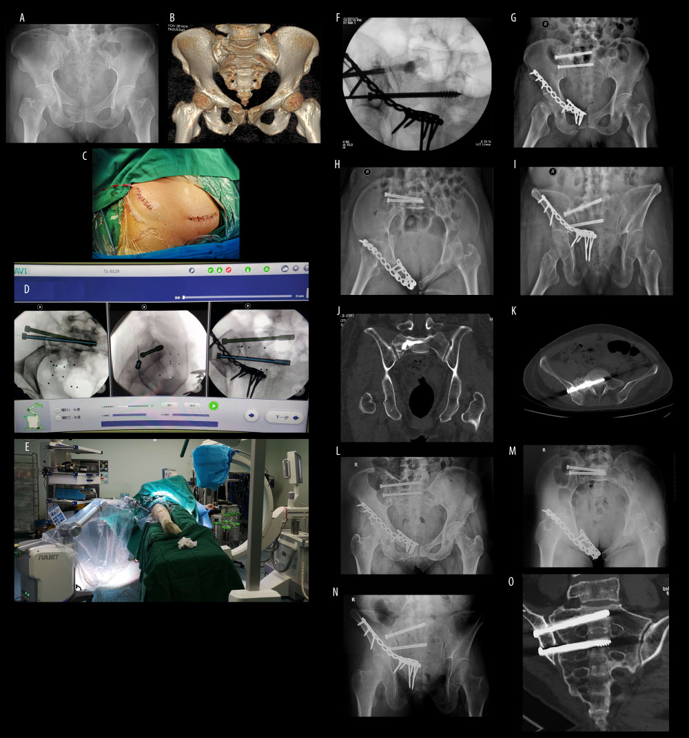 A 67-year-old woman with injury from falling from a height. (A) The anteroposterior pelvic view reveals displaced superior and inferior pubic rami fractures on the right side, close to pubic symphysis. (B) Computed tomography (CT) construction scan of the pelvic ring demonstrates the overlapping superior and inferior pubic rami fracture and the compression sacral fracture due to the internal rotation of the pelvis. It concerns a type B1 lesion according to Tile classification on pelvic fracture. (C) The medial and lateral incisions of anterior pelvis ring. (D) Path planning of sacroiliac screw placement in S1 and S2. (E) Overall view of robot-aided sacroiliac screw manipulation. (F) Bone grafting via sacroiliac screw channel under C-arm fluoroscopy. There is a dense shadow in sacral ala, showing the injectable bone substitute. (G–I) Postoperative anteroposterior, inlet and outlet views. (J, K) Coronal and transverse CT views showing the positioning of the sacroiliac screw and the bone grafting. (L–O) Anteroposterior, inlet and outlet views and CT scan at 6 months after surgery showing the union of sacrum.