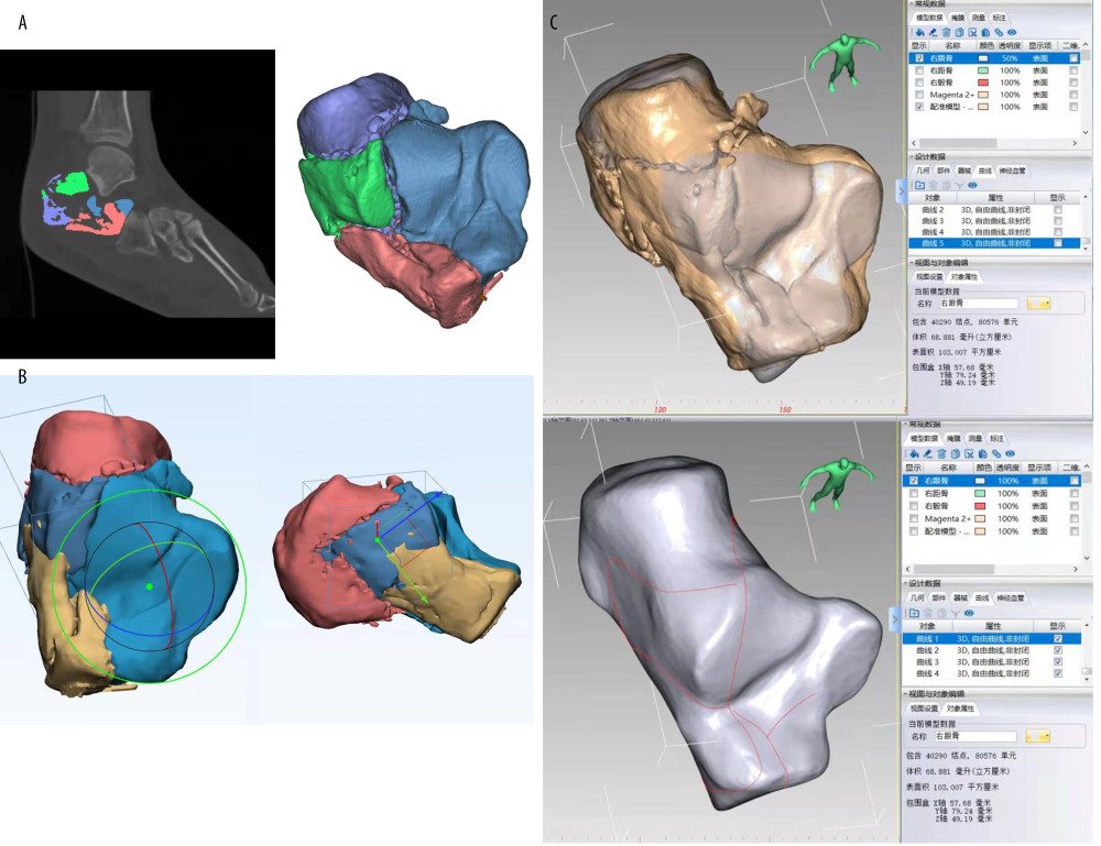 Flow charts of the calcaneal fracture map. (A) The segment and split functions were used to create each calcaneal fracture fragment by Mimics Research 20.0 (Materialise, Leuven, Belgium) software. (B) The calcaneal fracture fragments were reduced in 3-matic Research 12.0 (Materialise, Leuven, Belgium) software. (C) In the E-3D Medical 18.01(Central South University, Changsha, China) software, after superimposing the fractured calcaneus entity with the calcaneus template, draw the fracture line on the template.