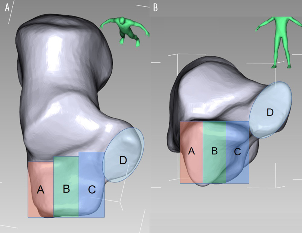 The division of the anterior part of calcaneus (APC) and middle talar articular surface. (A) Top view, (B) Front view.