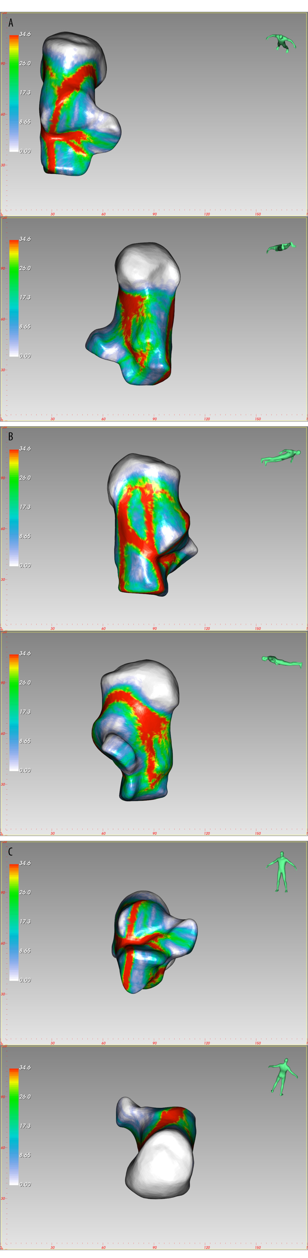 The fracture heatmap distribution of Sanders type 2 joint depression fracture, created by E-3D Medical 18.01 software (Central South University, Changsha, China). (A) Top view, Bottom view, (B) Lateral view, Medial view, (C) Front view, Rear view.