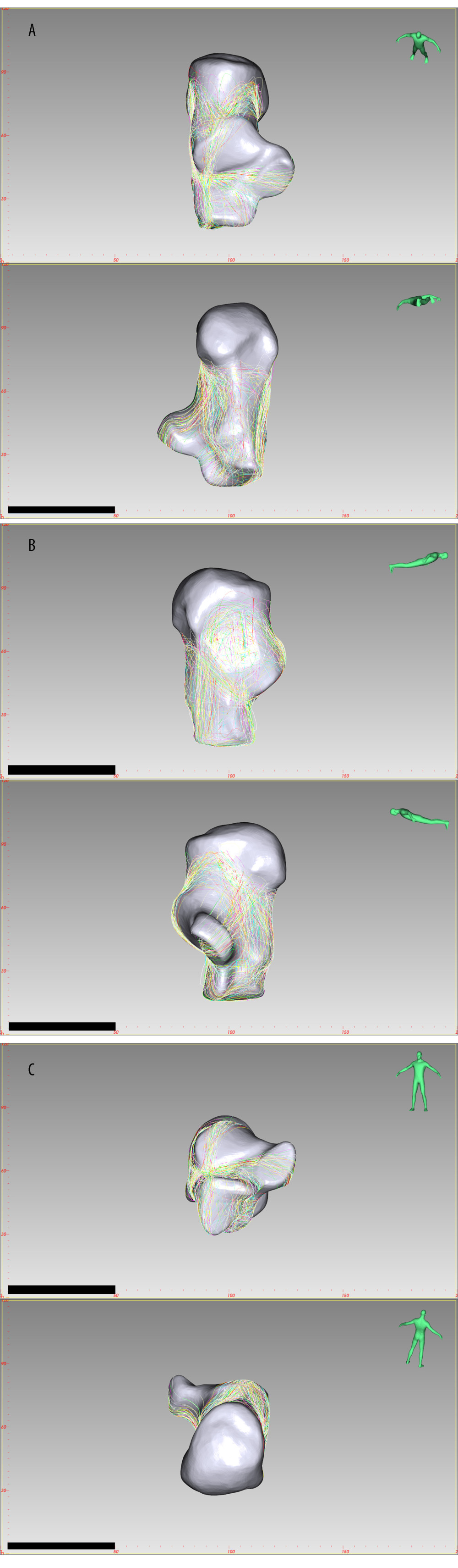 The fracture line distribution of Sanders type 2A joint depression fracture, created by E-3D Medical 18.01 software (Central South University, Changsha, China). (A) Top view, Bottom view, (B) Lateral view, Medial view, (C) Front view, Rear view.