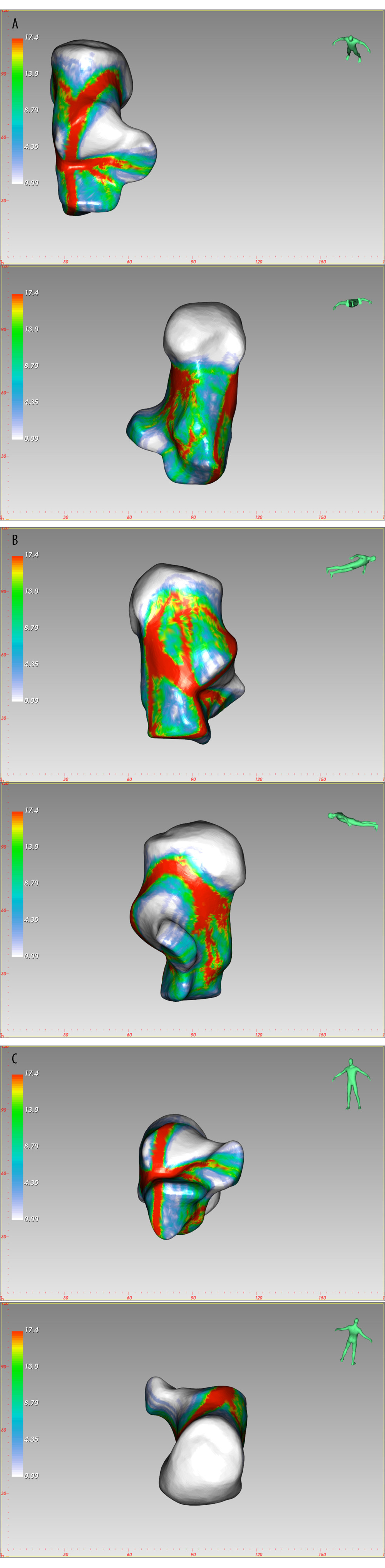 The fracture heatmap distribution of Sanders type 2A joint depression fracture, created by E-3D Medical 18.01 software (Central South University, Changsha, China). (A) Top view, Bottom view, (B) Lateral view, Medial view, (C) Front view, Rear view.