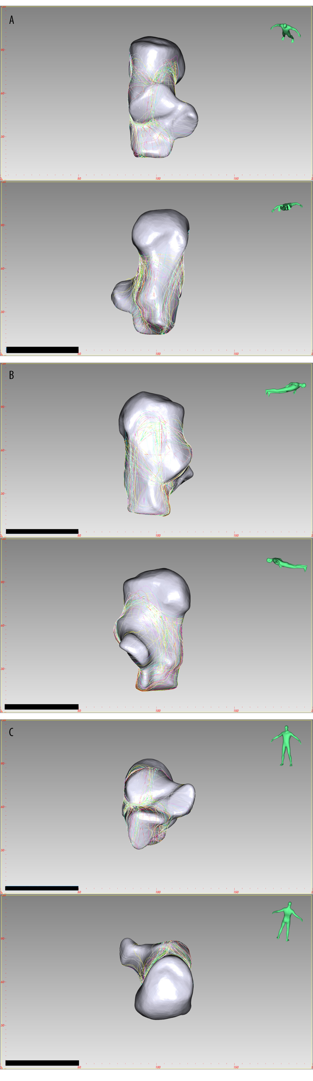 The fracture line distribution of Sanders type 2B joint depression fracture, created by E-3D Medical 18.01 software (Central South University, Changsha, China). (A) Top view, Bottom view, (B) Lateral view, Medial view, (C) Front view, Rear view.