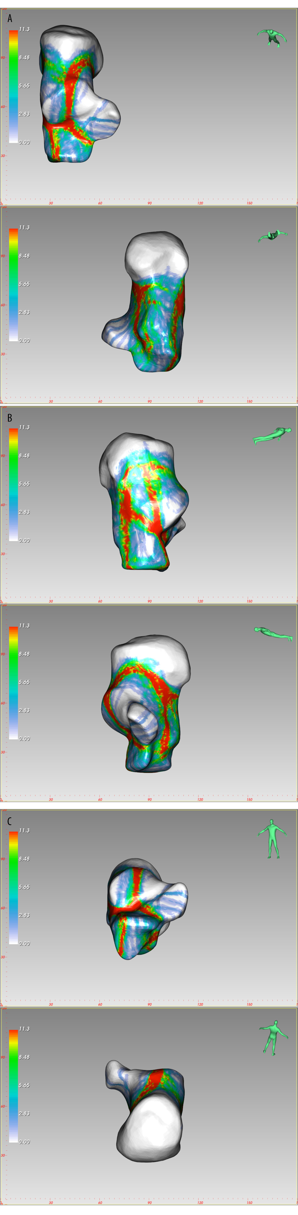 The fracture heatmap distribution of Sanders type 2B joint depression fracture, created by E-3D Medical 18.01 software (Central South University, Changsha, China). (A) Top view, Bottom view, (B) Lateral view, Medial view, (C) Front view, Rear view.