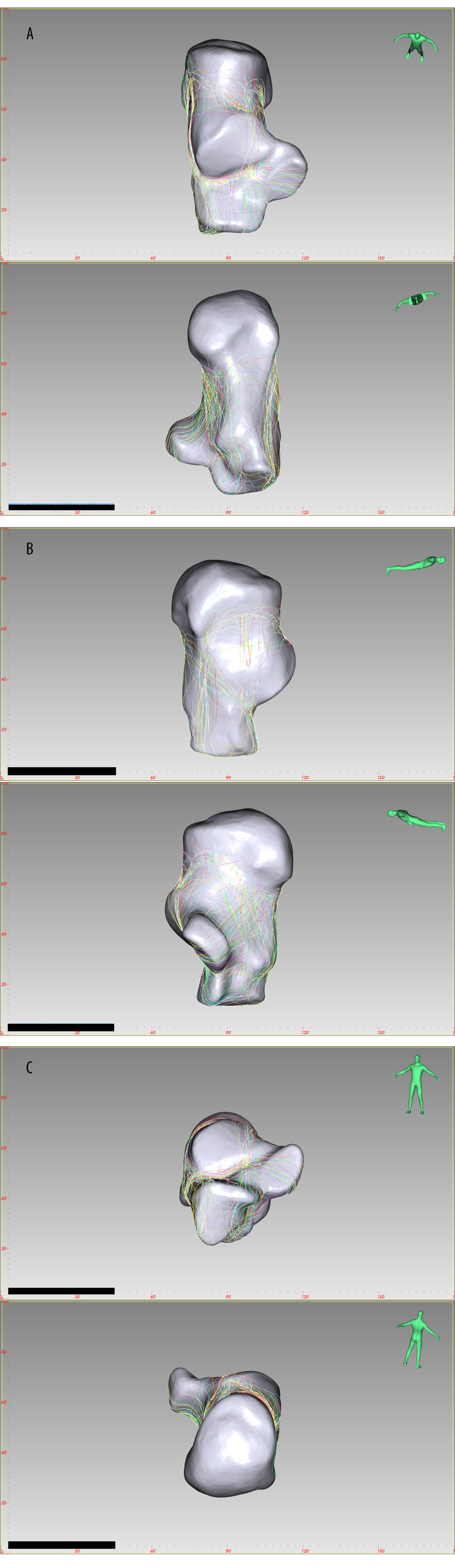 The fracture line distribution of Sanders type 2C joint depression fracture, created by E-3D Medical 18.01 software (Central South University, Changsha, China). (A) Top view, Bottom view, (B) Lateral view, Medial view, (C) Front view, Rear view.