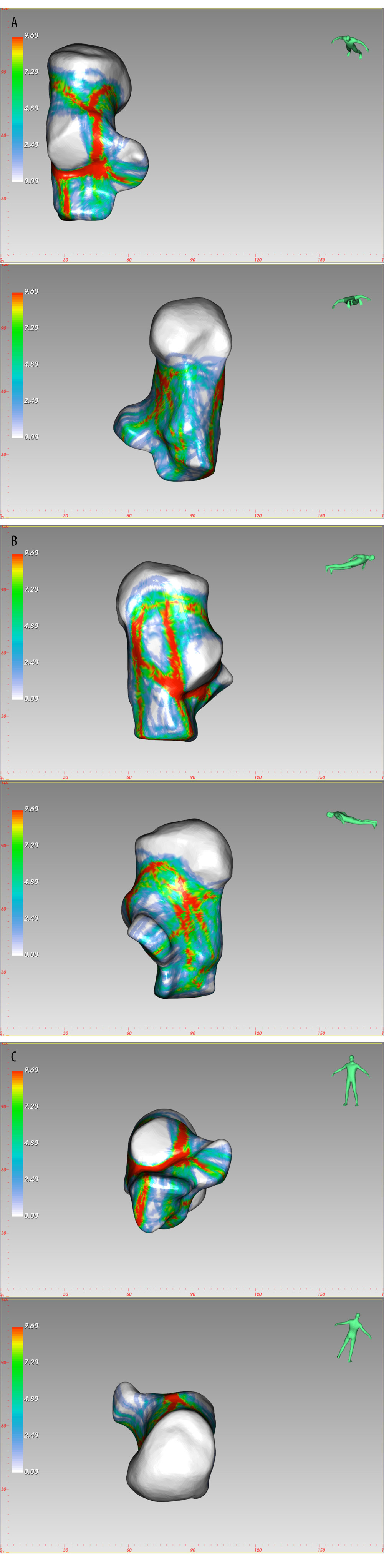 The fracture heatmap distribution of Sanders type 2C joint depression fracture, created by E-3D Medical 18.01 software (Central South University, Changsha, China). (A) Top view, Bottom view, (B) Lateral view, Medial view, (C) Front view, Rear view.
