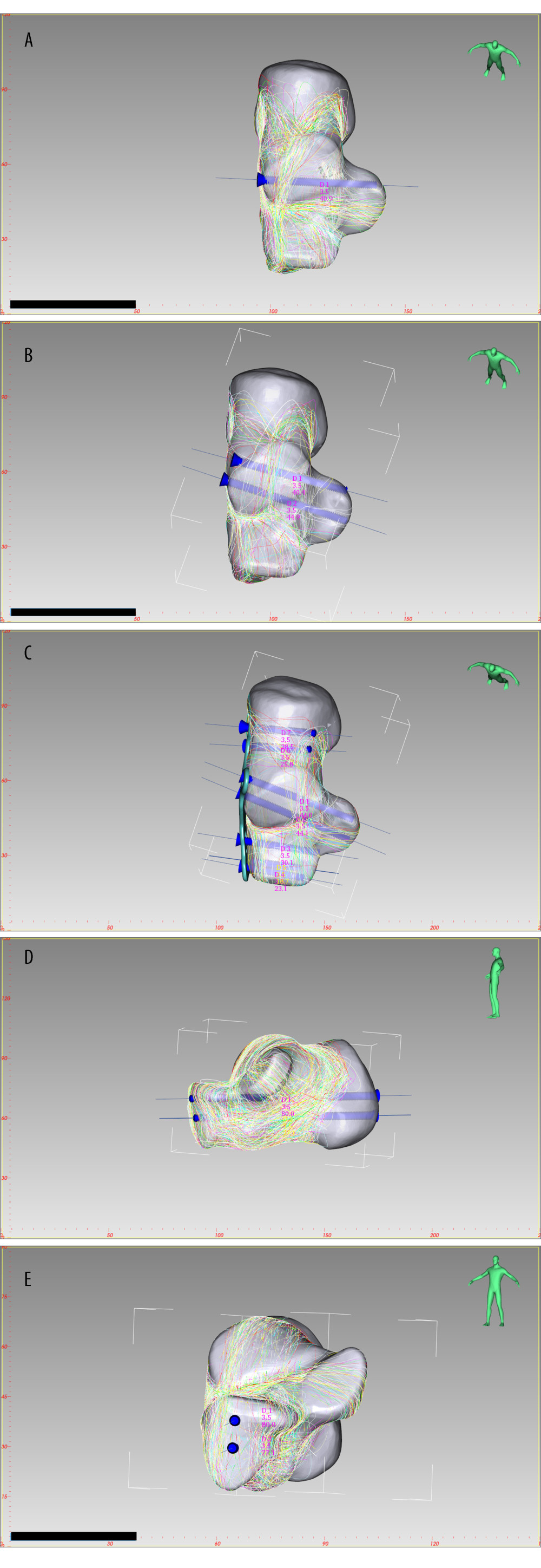 Optimal screw distribution in Sanders type 2A (A), Sanders type 2B (B) and Sanders type 2C (C) joint depression fracture. Optimal screw distribution in joint depression fracture (D, E) Medial view, Rear view. Created by E-3D Medical 18.01 software (Central South University, Changsha, China).