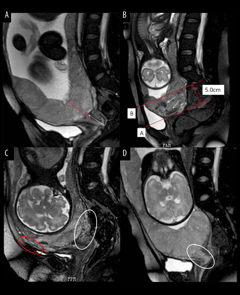 Different imaging characteristics of magnetic resonance imaging (MRI) in central placenta previa patients (Sagittal T2-weighted). (Microsoft office PowerPoint 2007, Microsoft, USA). (A) Placenta thickness: Placental thickness was measured from the internal cervix (red arrow); Cervical length: White arrow indicate the measurement of cervical length. (B) Placental dark T2 bands: The tangent line at the internal cervix (line A), parallel line 5 cm from line A (line B), the dark band (white arrow) between line A and line B is the area that we studied. (C). Cervical marginal sinus: Assessment of cervical marginal sinus signs using MRI (white circle); Myometrial thinning: The myometrium was partially defective, and placental tissue signals were seen in myometrium (red circle). (D). Placental signals in the cervix: Signs consistent with placental tissue were seen in the cervix, which means that the placenta may be inserted into the cervix (white circle); Lower uterine segment bulge: The placenta located entirely in the lower uterine segment, the lower uterine segment was enlarged and dilated.