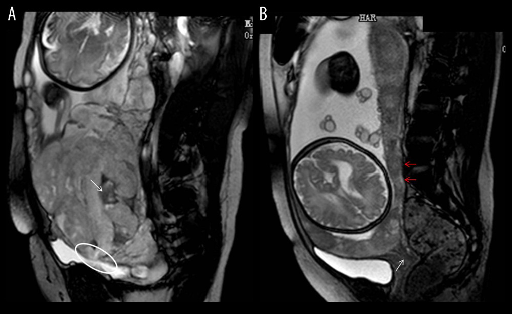 Magnetic resonance imaging (MRI) characteristics in central placenta previa patients with and without placenta accreta (Sagittal T2-weighted). (Microsoft Office PowerPoint 2007, Microsoft, USA). (A) Central placenta previa with placenta accrete: Placenta thickness is 12.3 centimeters; The cervical canal is almost completely eroded by the placenta and we can hardly see a clear cervix; The placental signal is heterogeneous and many dark T2 bands are seen in the placenta (white arrow); The whole placenta is located in the lower part of the uterus, which is dilated; A partial myometrium defect can be seen at the uterine and placental interface (white circle); (B) Central placenta previa without placenta accrete: Placenta thickness is 3.2 centimeters; We can see a clear cervix (white arrow); Placenta signals are homogeneous; The boundary between the uterine myometrium and placenta is clear (red arrow).