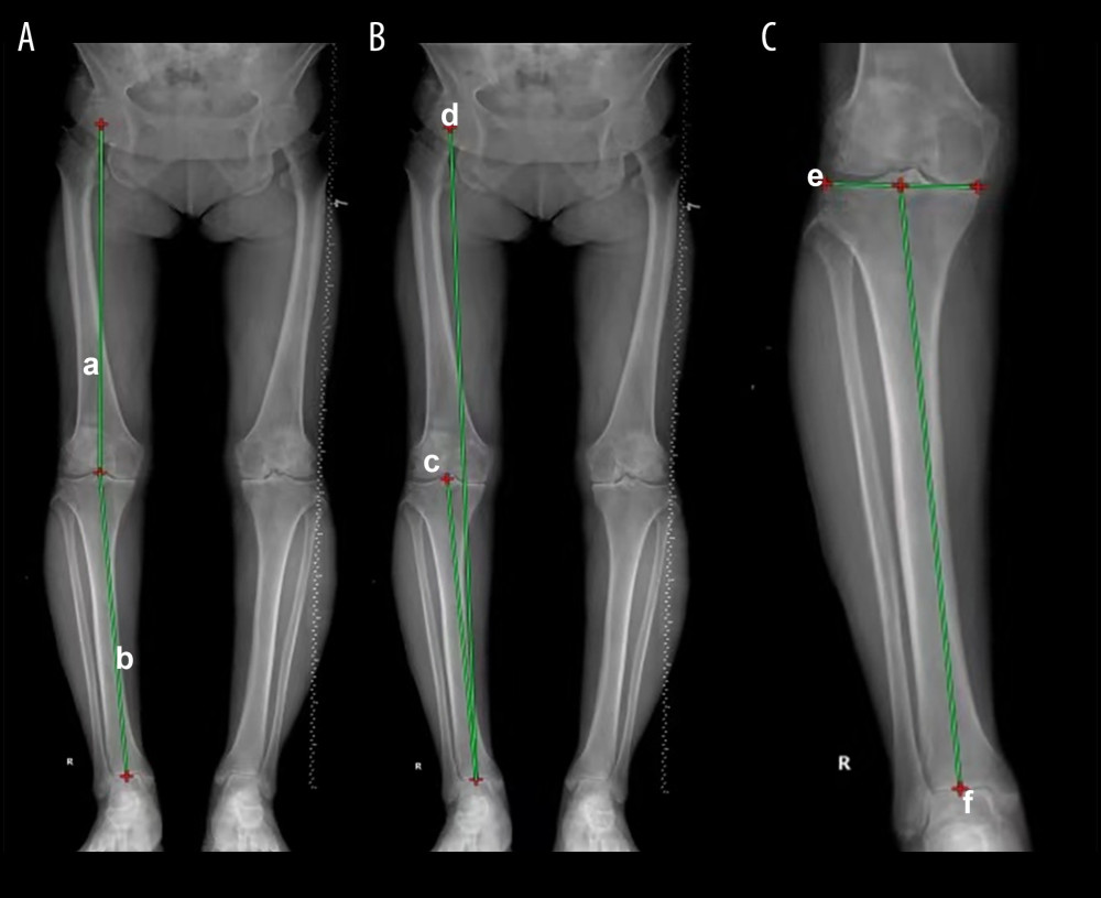 Measurement of hip-knee-ankle angle (HKA) and ankle parameters based on full-leg standing anteroposterior radiographs. HKA was defined as the medial angle between (a) and (b) (A). Lateral tibial angle was defined as the medial angle between (c) and (d) (B). Medial angle of the proximal tibia was defined as the lateral angle between (d) and (f) (C).