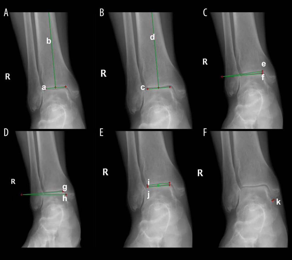 The tibia anterior surface angle was defined as the angle between (a) and (b) (A). The tibia talar surface angle was formed by the angles between (c) and (d) (B). Angle between the ground and the upper surface of talus was defined as the angle between (e) and (f) (C). The talar tilt angle was defined as the angles between (g) and (h) (D). The medial ankle joint space was defined as the medial angles between (i) and (j) (E). Moreover, medial ankle clear space was defined as the line k from the medial malleolus to the lateral malleolus (F).