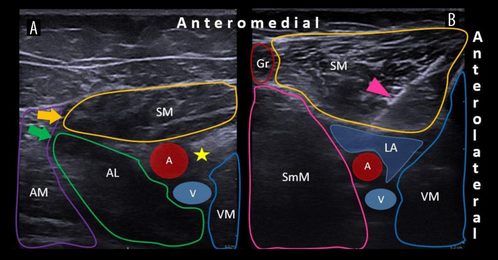 The ultrasonographic views: the apex of the femoral triangle (A) and the distal end of the adductor canal (B). The apex of the femoral triangle (A) was found at the level where the medial border of the sartorius muscle (yellow arrow) intersects the medial border of the adductor longus muscle (green arrow). Local anesthetic was injected laterally to the femoral artery (yellow star) where the saphenous nerve is located. The distal end of the adductor canal (B) was found at the level where the femoral artery and vein dive deeper from the sartorius muscle and become the popliteal vessels. The needle (pink arrowhead) was placed and the local anesthetic was injected above the artery. SM – sartorius muscle; AL – adductor longus muscle; VM – vastus medialis muscle; AM – adductor magnus muscle; Gr – gracilis muscle; SmM – semimembranosus muscle; A – femoral artery; V – femoral vein; LA – spread of local anesthetic after injection.