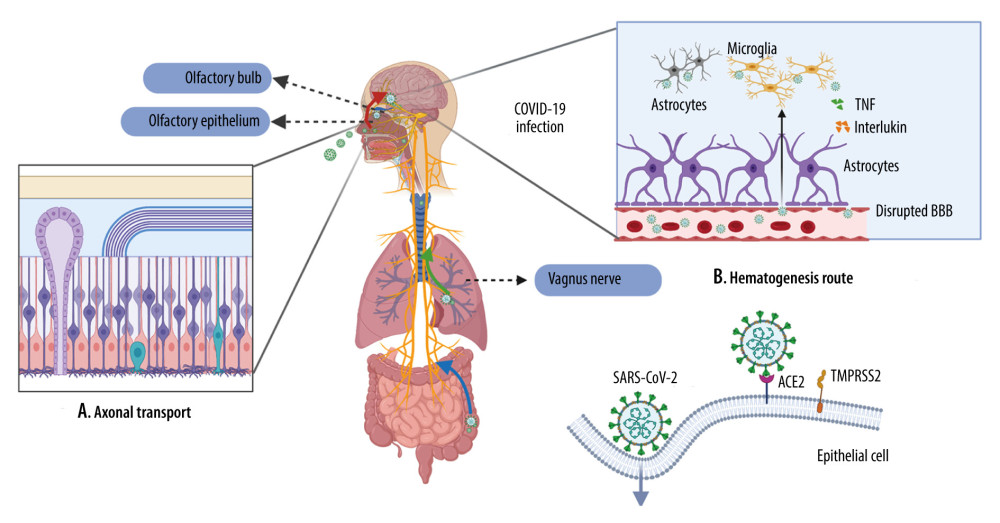Viral journey to the central nervous system (CNS)A. Axonal transport. Severe acute respiratory syndrome coronavirus 2 (SARS-CoV-2) has been shown in the olfactory epithelium, where they can disseminate along the olfactory nerve, ascending from the cribriform plate into the olfactory bulb, then disseminate throughout the CNS via interconnected neurons. SARS-CoV-2 is also presented in the lungs and the gastrointestinal tract, where they can spread along the vagus nerve to reach the CNS, including the brainstem. B. Hematogenesis dissemination. SARS-CoV-2 first invades peripheral epithelial cells, which express ACE2 and TMPRSS2. Once inside the bloodstream, the virus penetrates through the impaired BBB and invades the CNS. (Created with BioRender.com).