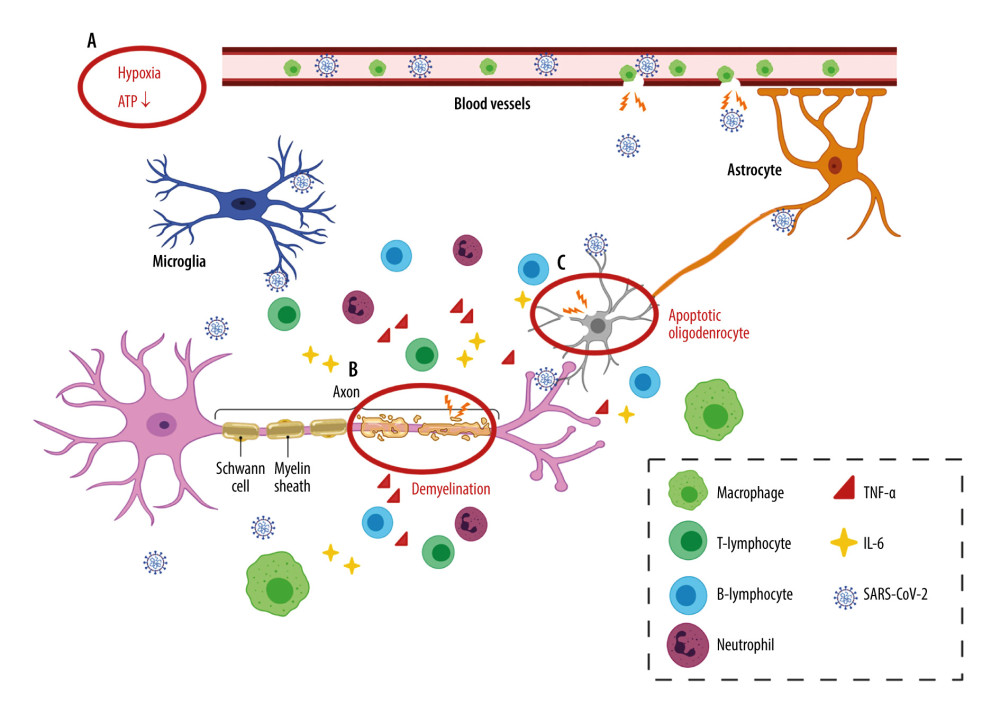 Neuroinflammation in the CNSA. Hypoxia. Inadequate oxygen supply to the brain leads to ATP crisis and exacerbated inflammatory state. B. Demyelination. A leaky BBB allows the entrance of virus and peripheral lymphocytes into the CNS, resulting in activation of microglia. Reactivated microglia release inflammatory cytokines (TNF-α and IL-6), contributing to demyelination and neuron death. C. Oligodendrocyte apoptosis. Infiltrating neutrophils adversely impact neuronal function by inducing oligodendrocyte apoptosis. (Created with BioRender.com).