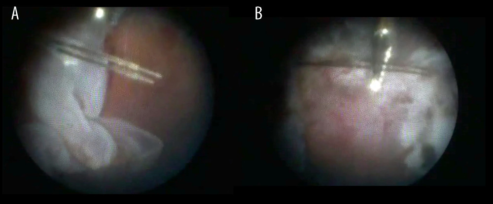 (A, B) The left eye was injured by an iron hook in patient 14, with traumatic retinal choroidal detachment and intraocular foreign body (2 cilia and a glass foreign body were located at the curl of the retinal wound). Preoperative visual acuity was light perception and postoperative visual acuity was hand movement.