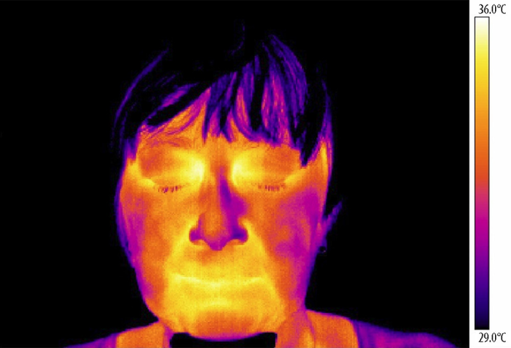Thermography of orofacial area before therapy (orofacial pain on right side).