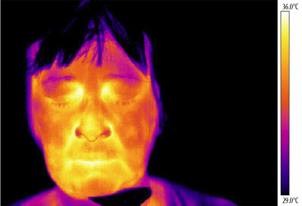 Thermography of orofacial area after therapy (orofacial pain on right side).