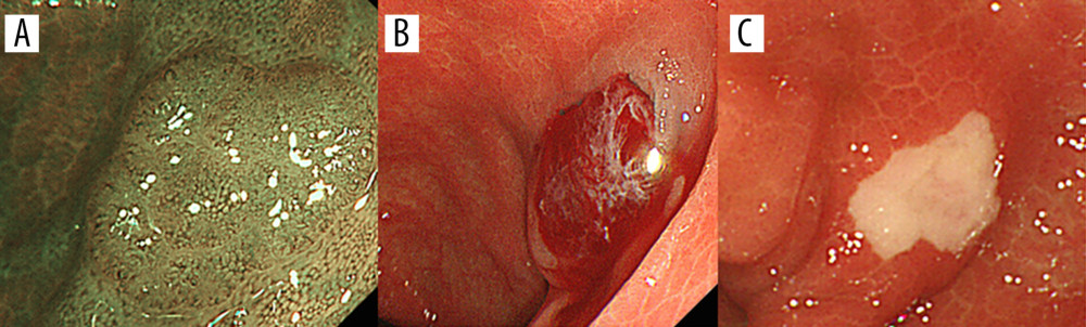 Representative case of CP. (A) A non-polypoid (IIa) lesion (6 mm) located in the descending colon. (B) The lesion was resected en bloc by CSP. (C) One week after CP, the ulcer was 3 mm and no exposed blood vessels were observed. CP – cold polypectomy; CSP – cold snare polypectomy.