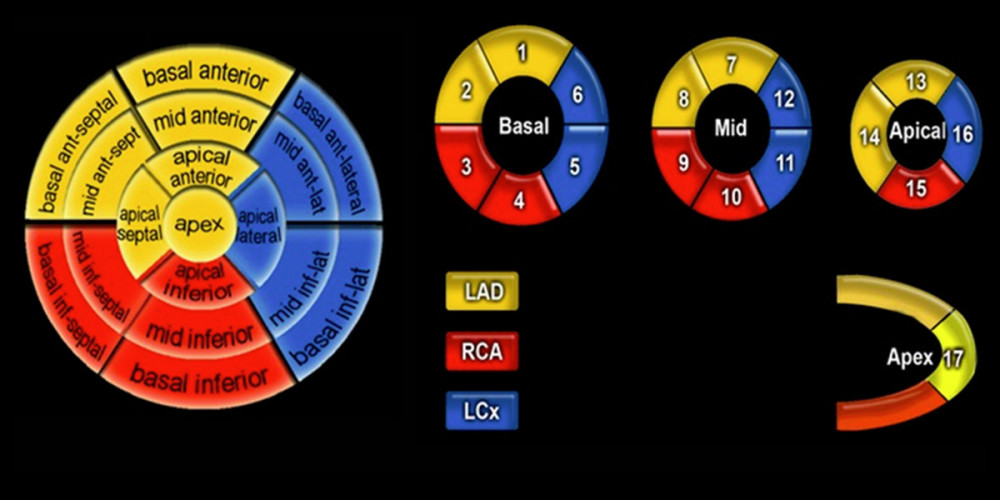 The 17 myocardial segments of the left ventricle presented by AHA and their corresponding coronary artery anatomy.