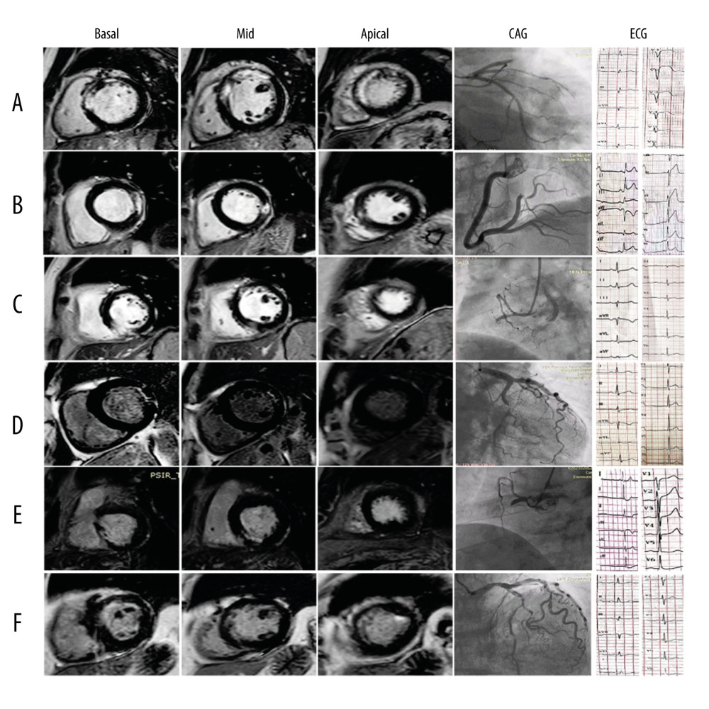 Images from 6 AMI patients. (A) ECG in leads V1–V5 manifests ST-elevation in a 57-year-old man. CMR illustrates transmural infarction in the anterior segments detected by DE-MRI. Coronary angiography revealed LAD 100% occluded proximally. (B) ST-segment elevation on ECG in leads II, III, and aVF in a 48-year-old man. CMR illustrates contrast-enhanced areas in the lateral segments characterized by DE-MRI. Coronary angiography revealed a 99% distal stenosis in the RCA. (C) A 58-year-old MI patient with a normal ST segment. CMR shows contrast-enhanced areas in the inferior segments characterized by DE-MRI. Coronary angiography revealed 100% proximal occluded RCA. (D) A 55-year-old woman with MI with a normal ST segment. CMR illustrates non-transmural hyperenhancement in the lateral segment. Coronary angiography revealed 95% middle stenosis in the LCx. (E) ECG of a 50-year-old patient showing presence ST-depression in inferior leads. CMR showed partial transmural and subendocardial necrosis in the inferior segments detected by DE-MRI. Coronary angiography revealed 100% proximal occluded RCA. (F) ECG of a 66-year-old woman presenting non-ST-segment elevation in anterior leads. CMR showed non-transmural hyperenhancement in the anterior segment detected by DE-MRI. Coronary angiography revealed 95% proximal stenosis in the LAD. DE-MRI – delayed-enhancement magnetic resonance imaging; MI – myocardial infarction; LAD – left anterior descending artery; LCx – left circumflex; RCA – right coronary artery.