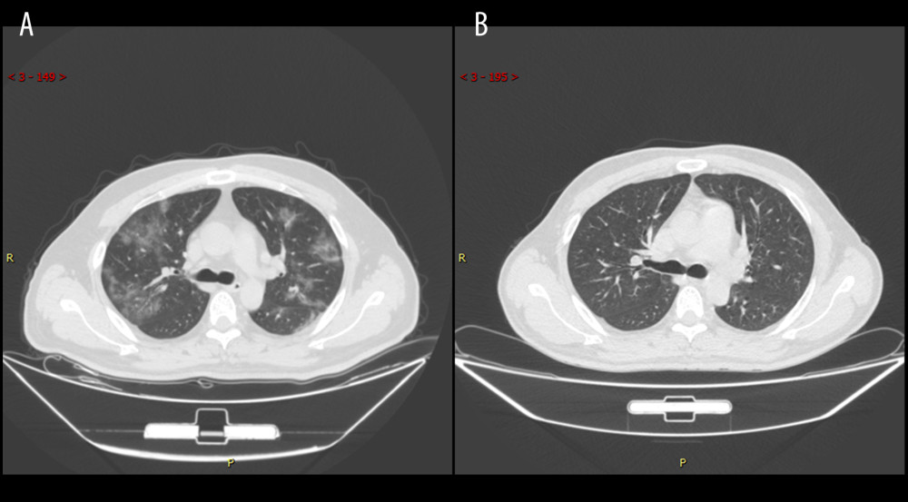 Series computed tomography (CT) scans in 39-year-old man with COVID-19 pneumonia. (A) CT scan obtained on illness day 7 shows diffuse ground-glass opacity. (B) CT scan obtained of illness at month 5 shows that the lesion had been absorbed.