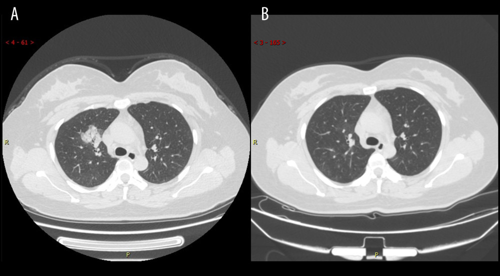 Series computed tomography (CT) scans in a 34-year-old woman with COVID-19 pneumonia. (A) CT scan obtained on illness day 10 shows consolidation in right lung. (B) CT scan obtained at month 2 shows the obvious absorption of abnormalities.