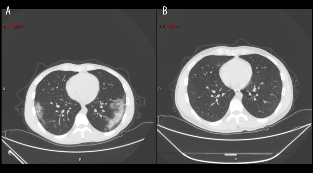Series computed tomography (CT) scans in 29-year-old man with COVID-19 pneumonia. (A) CT scan obtained on illness day 17 shows ground-glass opacity combined with partial consolidation. (B) CT scan obtained at month 2 shows that the lesion had been absorbed.