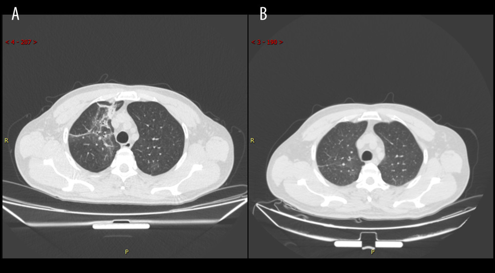 Series computed tomography (CT) scans in 48-year-old man with COVID-19 pneumonia. (A) CT scan obtained on illness day 3 shows mixed pattern (with ground-glass opacity, reticular pattern, and consolidation. (B) CT scan obtained at month 2 shows the obvious absorption of abnormalities.