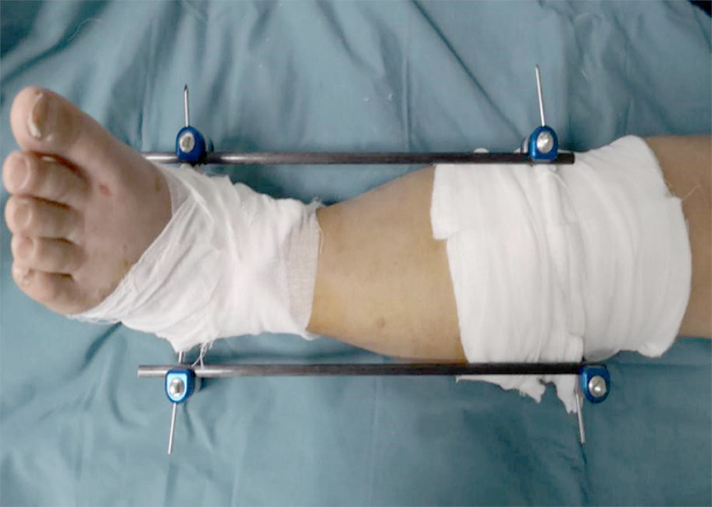 Modified external fixation.