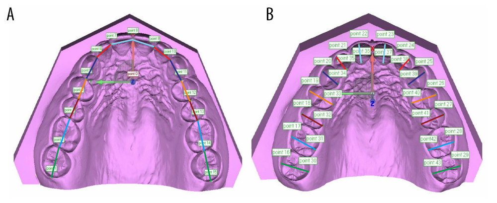 Measurements on mesiodistal distance (A) and buccolingual distance (B) of maxillary teeth on 3-dimensional digital dentition.