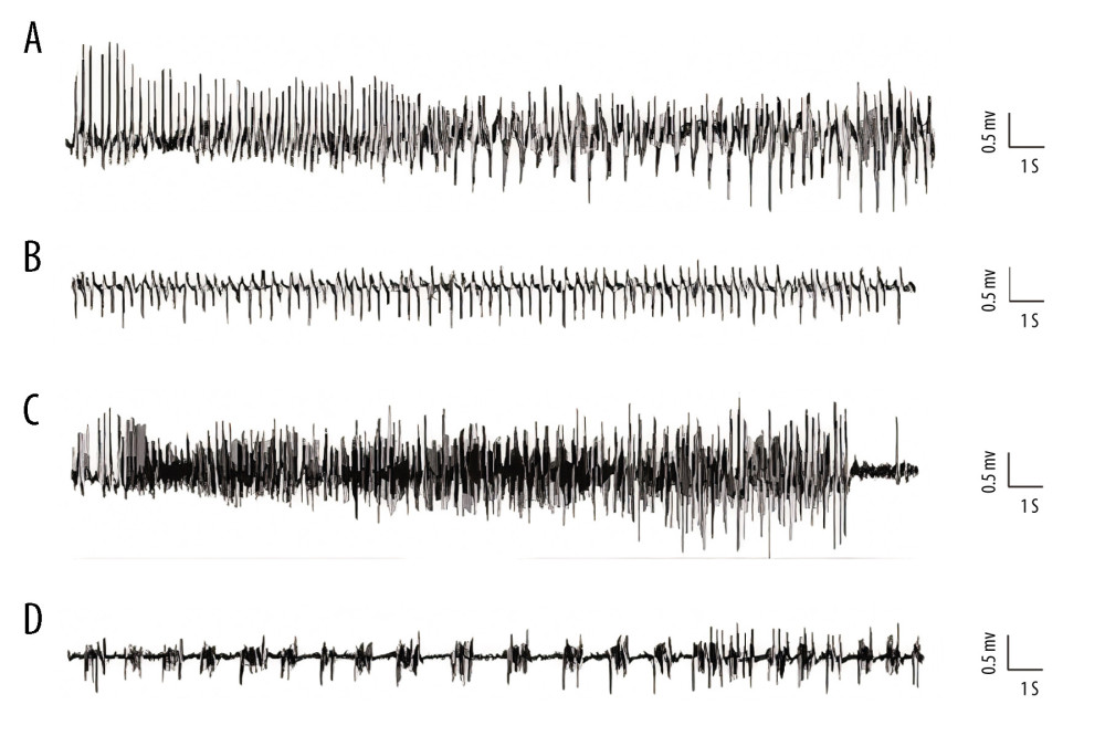 Representative kainic acid-induced seizure patterns on electroencephalogram in the present study. (A) Irregular high-amplitude spikes. (B) periodic epileptiform discharges. (C) High-frequency bursting. (D) A combination of periodic epileptiform discharges and high-frequency bursts of short duration. (Prism 8, version 8.3.0).