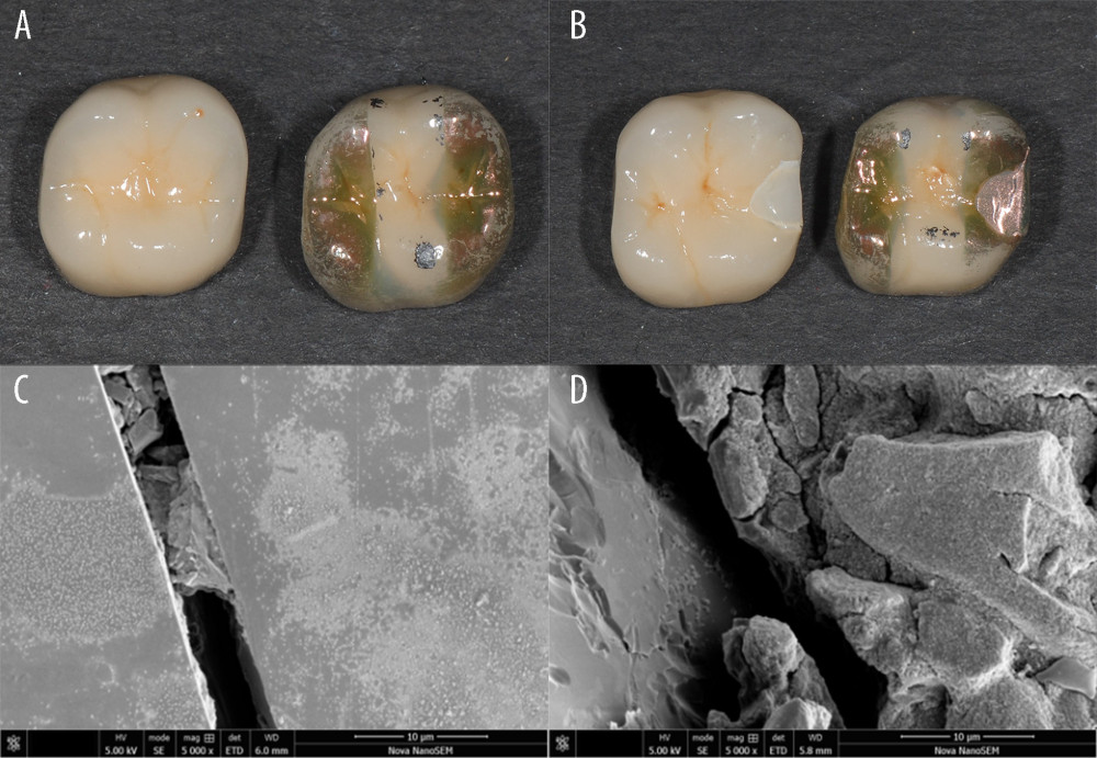 Impact-simulated wear test. (A, B) Representative images for the specimens before and after the impact-simulated wear test. (C, D) Scanning electron microscope images of impact-simulated wearing test from occlusal surfaces. The specimens were fractured and there was a lack of fragmenting powder in the fracture and the crack. (A, C) Representative images for the control group. (B–D) Representative images for the mesio-distal adjustable crown prosthesis group.