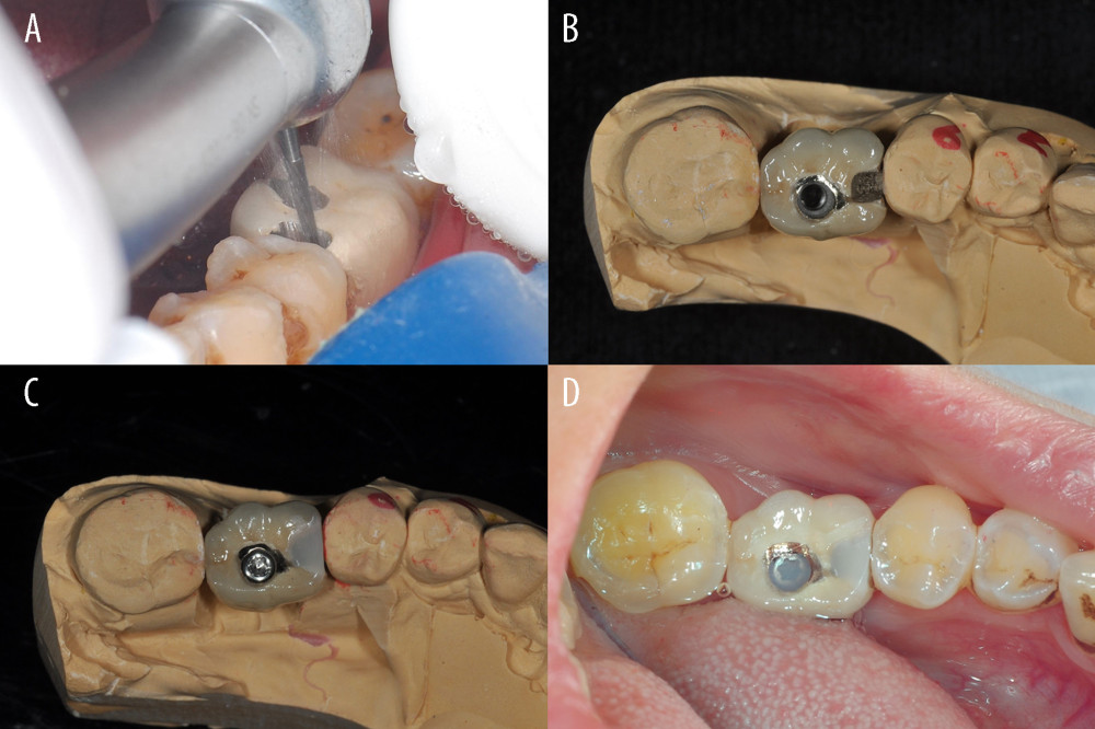 Prosthetic procedure and clinical procedure of mesio-distal adjustable (MDA) crown. (A) Wax model of the MDA crown. (B, C) Definitive prosthesis with mesial framework and screw access opening. (D) After removal of the healing abutment, note that the screw-retained prosthesis is seated in the implant.