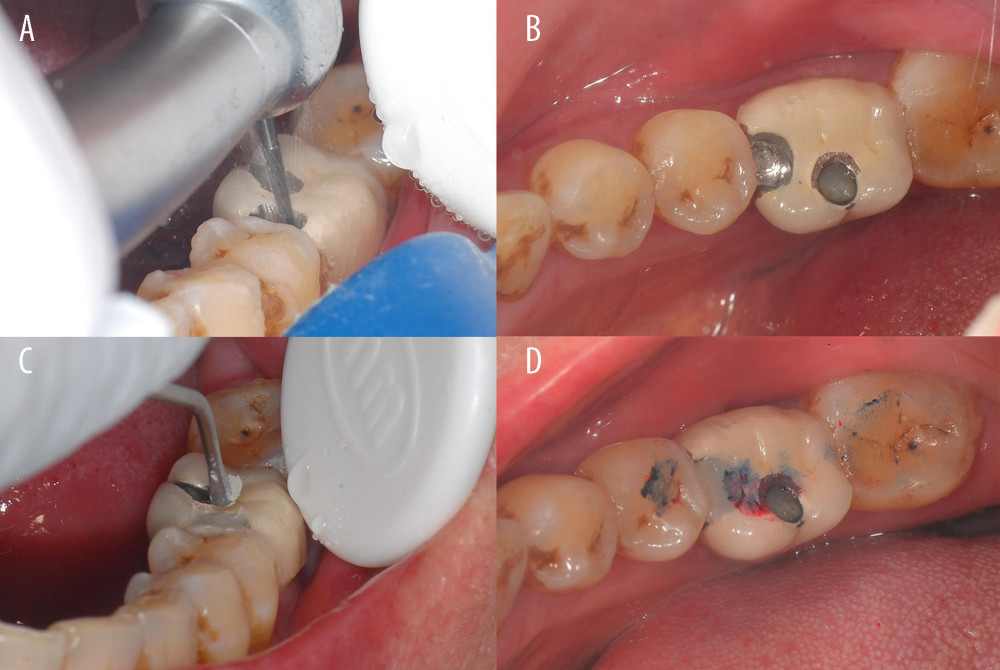 Treatment of proximal contact loss by mesio-distal adjustable crown. (A, B) Removing the original resin filling from the framework. (C, D) Refilling the framework with light-cured composite resin.