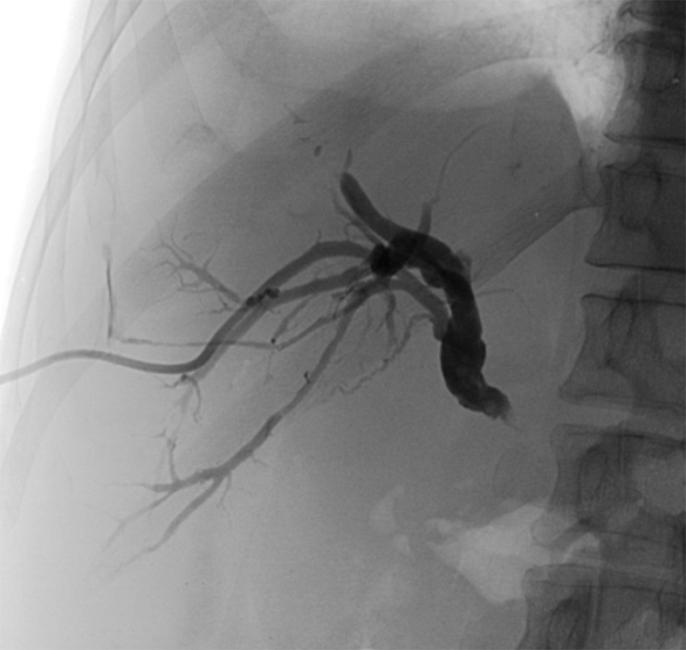 Control radiography performed after drainage catheter placement. Software used for creation of the figure: Advantage Workstation Software V4.6, General Electric.