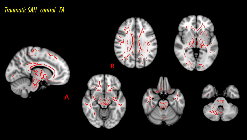Results of tract-based spatial statics analysis comparing fractional anisotropy (FA) values between the patient and control groups. FA values are acquired for 48 regions of interest (ROIs) applying the white matter atlases standard template of Johns Hopkins University through the Functional Magnetic Resonance Imaging of the Brain Software Library (FSL version 5.1). The red voxels represent areas where the mean FA values are significantly higher in the control group than in the patient group. The FA values of 19 of 48 ROIs (splenium, genu, and body of the corpus callosum, both posterior limbs of the internal capsule, both corticospinal tracts, both superior corona radiata, both superior cerebellar peduncles, the middle cerebellar peduncle, the left anterior limb of the internal capsule, the left external capsule, the right cingulum, the left superior longitudinal fasciculus, the left cingulum, the left cerebral peduncle, the right posterior corona radiata) in the control group are higher than those of the patient group.