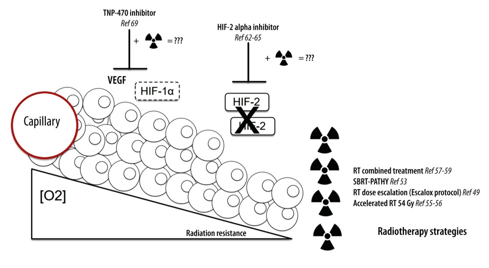Strategies to overcome hypoxia-induced radioresistanceUnder hypoxic conditions, the HIF-1α subunit translocates to the nucleus and binds HIF-1β. This results in the transcriptional activation of many genes, which plays a role in tumor progression. Both HIF-1 and HIF-2 stimulate transcription of vascular endothelial growth factor (VEGF), a crucial regulator of vascular development. Different strategies have already been tested to overcome hypoxia-induced radioresistance. (1) The ESCALOX protocol concluded that dose escalation to large parts of the tumor was associated with the risk of more acute and late toxicity. (2) Stereotaxic body radiation therapy showed very encouraging results for very large unresectable tumors. (3) Accelerated radiotherapy induced tumor radiosensitivity. As perspective, in vitro TNP-470, an angiogenesis inhibitor, could increase tumor oxygenation and radiosensitivity. Likewise, HIF-2α (PT2385) inhibition enhanced radiation sensitivity in a cellular model of lung cancer by promoting apoptotic activity via the p53 pathway. The association of radiotherapy and TNP-470 and/or PT2385 should be investigated.
