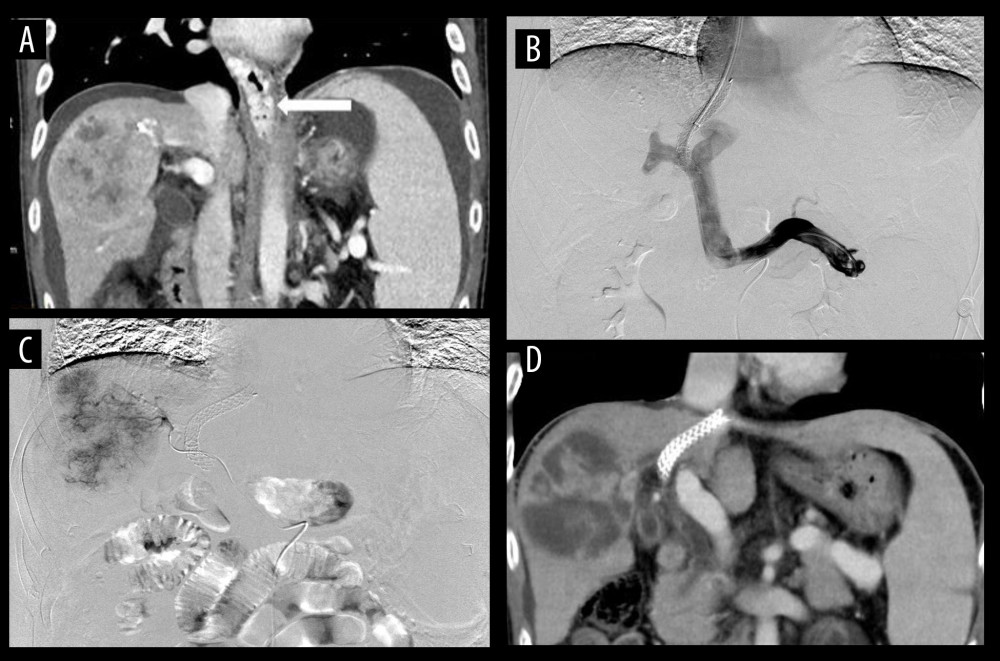 (A) The examination of esophageal and gastric varices (white arrow), peritoneal effusion, and hepatocellular carcinoma by computed tomography (CT) in patients. (B) The effective shunt function of the stent through angiography under transjugular intrahepatic portosystemic shunt (TIPS), with implantation of 8×70-mm Viatorr stent. (C) In patients undergoing transarterial chemoembolization (TACE), the staining of hepatocellular carcinoma was obvious and embolization with drug-loaded microspheres was performed. (D) At the 1-month follow-up after TACE, most of the hepatocellular carcinoma was necrotic, the stent was unobstructed, and the peritoneal effusion disappeared.