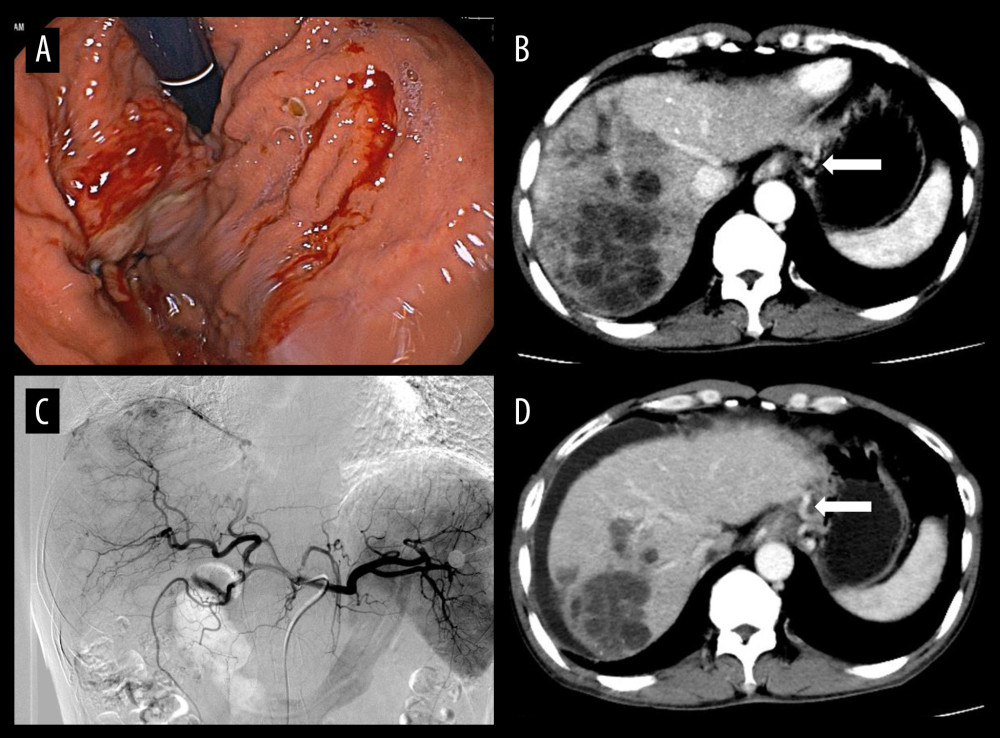 (A) Gastroscopy revealed varices in the fundus of the stomach, which showed bleeding and rupture of blood vessels. Under the gastroscope, application of titanium clips to hemostatic varicose veins and tissue glue injection were used to stop the bleeding. (B) The hepatocellular carcinoma and gastric fundus varices (white arrow) by computed tomography examination. (C) In patients undergoing transarterial chemoembolization (TACE), the staining of hepatocellular carcinoma was obvious and embolization with drug-loaded microspheres was performed. (D) At the 1-month follow-up after TACE, most of the hepatocellular carcinoma was necrotic, but there was peritoneal effusion, and the gastric fundus varices were still not relieved (white arrow).