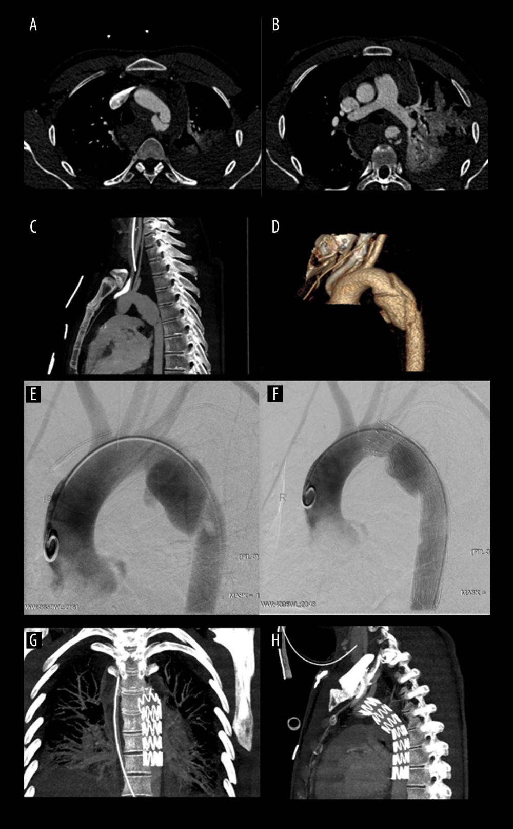 Thoracic aortic injury with active bleeding(A) Computed tomography (CT) angiogram of the axial maximum intensity projection (MIP) reconstruction with aortic trauma in loco typico. (B) CT showing left hemothorax, pulmonary trauma, and active bleeding. (C) CT MIP sagittal projection with aortic grade IV trauma. (D) CT volume rendering technique reconstruction of the aortic wall trauma grade IV. (E) Digital subtraction angiography with active contrast agent leakage. (F) ZDEG (Cook) stent graft implantation before the origin of the left vertebral artery with left subclavian artery coverage. (G) CT follow-up in coronal projection. (H) CT follow-up in sagittal projection.