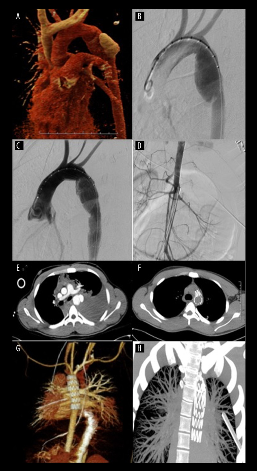Tension hemothorax after thoracic aortic transection(A) Computed tomography (CT) angiogram volume rendering technique (VRT) reconstruction with contrast agent leakage. (B) Digital subtraction angiography showing dissection in loco typico. (C) ZDEG (Cook) stent graft implantation. (D) Abdominal aorta hypovolemia. (E) CT showing severe hemothorax and aortic injury. (F) CT follow-up after stent graft and hemothorax drainage. (G) CT angiogram follow-up 3D VRT reconstruction after stent graft placement. (H) CT follow-up maximum intensity projection after hemothorax drainage.