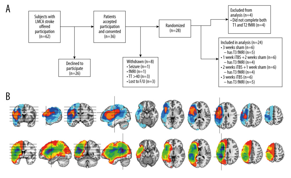 Overview of CONSORT flow diagram (A) and composite lesion maps for the iTBS treatment groups (B). (A) The diagram outlines recruitment of subjects who suffered a left middle cerebral artery (LMCA) stroke and how many participants did and did not complete both fMRI visits at baseline within 1 week of iTBS treatment initiation (T1), within one week of treatment completion (T2), and again after 12 weeks following treatment completion (T3). (B) The composite lesion map color scale for the sham iTBS group (top; n=6) ranges from the minimum (n=1 in light blue) to the maximum (n=6 in yellow) number of participants that show overlap of lesions in 2 locations indicated by the crosshairs in the sagittal and axial slices. The composite lesion map color scale for the active iTBS group (bottom; n=18) ranges from the minimum (n=1 in dark orange) to the maximum (n=14 in maroon) number of participants that show overlap of lesions in 2 locations indicated by the crosshairs in the sagittal and axial slices. Left in the image is left in the brain. The inferior to superior horizontal lines on the coronal images indicates each axial slice from left to right.