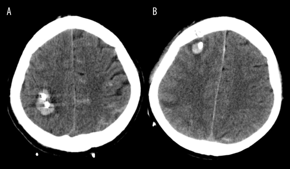 (A, B) Illustration of catheter tract hemorrhage on axial computed tomography scan obtained after surgery.The figure was created by the author from the PACS database of our institution using FastStone capture 9.0 (FastStone Soft).