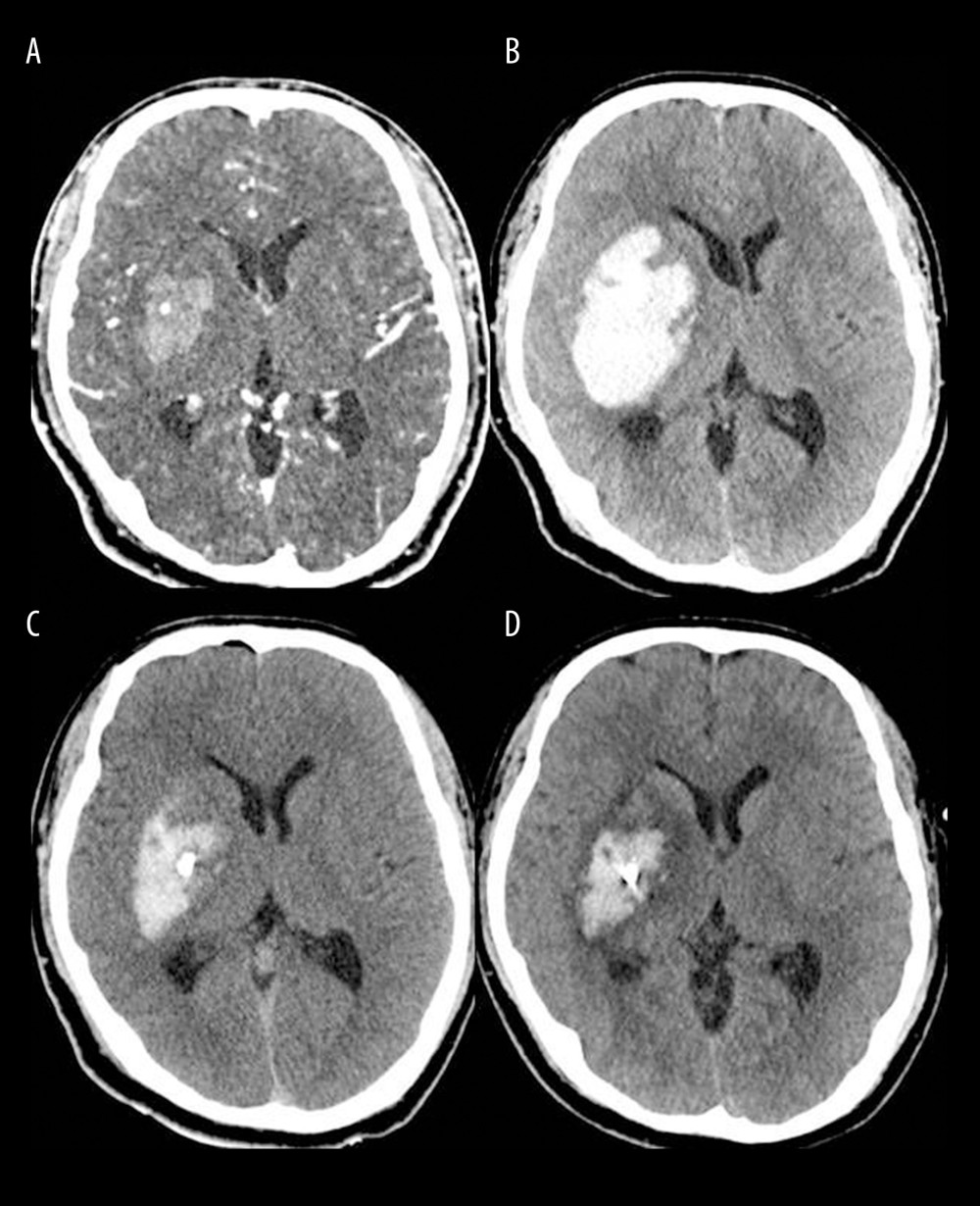 Brain computed tomography (CT) scans of a successful case of hematoma removal using single-catheter insertion in neuronavigation-assisted stereotactic aspiration and thrombolysis surgery(A) Spontaneous intracerebral hemorrhage of 15 mL in the right basal ganglia with the spot sign on the initial CT angiography scan. (B) Marked volume enlargement on the follow-up CT scan (57 mL). (C) Remarkable decrease in the hematoma volume after single-catheter insertion on the postoperative CT scan. (D) Approximately 80% of the hematoma had been removed as a result of tissue plasminogen activator administration on the follow-up CT scan 2 days after surgery. The figure was created by the author from the PACS database of our institution using FastStone capture 9.0 (FastStone Soft).