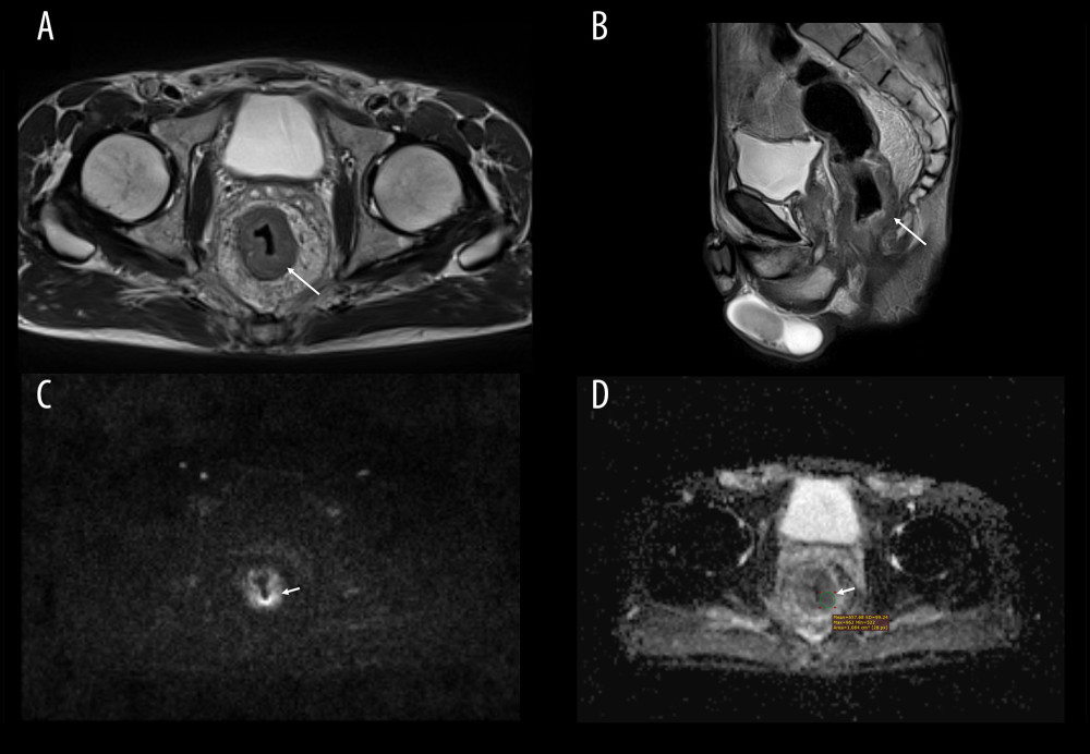 Magnetic resonance (MRI) scans of a 57-year-old man with rectal cancer. A thickened rectal wall on (A) axial and (B) sagittal T2-weighted image (long arrows). High signal on (C) diffusion-weighted image b=1000 s/mm2 and low signal on (D) corresponding apparent diffusion coefficient (ADC) map indicates the presence of water diffusion restriction, the feature of malignancy (short arrows). (D) Region of interest (ROI) of about 1 cm2 is placed within the borders of the tumor on the ADC map (circle). Measurement of mean ADC value and in-ROI ADC standard deviation. Medixant, RadiAnt DICOM Viewer (version 2020.2.3).
