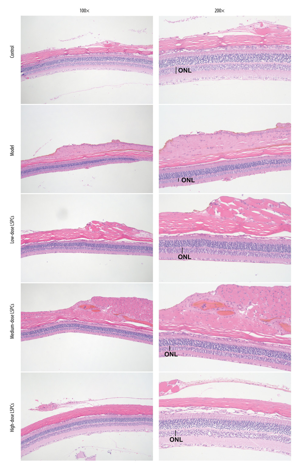 Protective roles of LSPCs on retinal structure in light-induced retinal damage rats. Histological analysis was carried out utilizing H&E staining. Representative images of H&E staining of control, light exposure-induced retinal injury model, low-, medium-, and high-dose LSPCs groups were shown, separately. Magnification, 100× or 200× bar value, 50 or 100 μm. Olympus software (version 2.2; Olympus, Japan) was used to create the pictures.