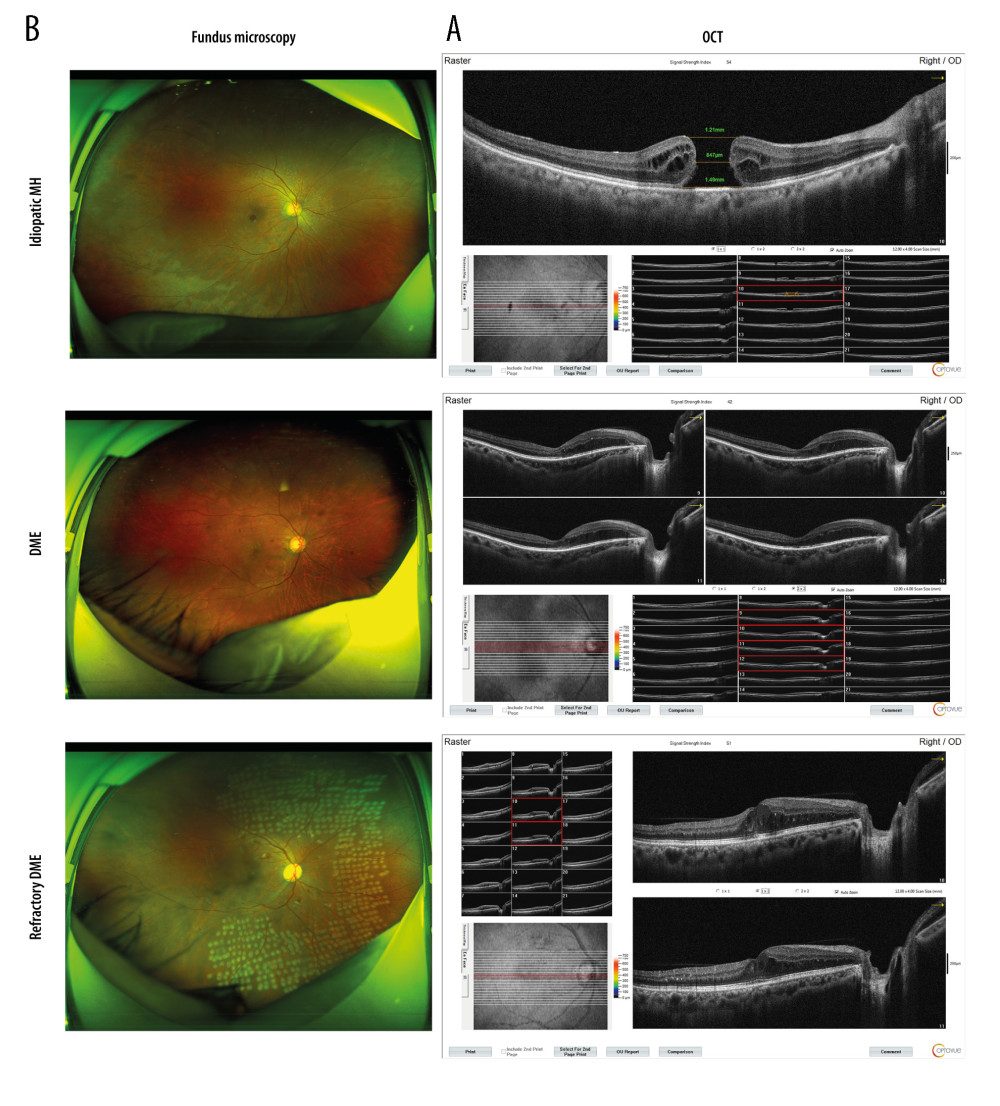 DME exacerbated the symptoms of macular edema. (A) OCT analyses of the retinal symptoms among patients in different groups; (B) fundus microscopy to analyze the differences in macular edema area and eyeball characteristics among patients in different groups. * P<0.05; OCT – optical coherence tomography; DME – diabetic macular edema; MH – macular hole. Photoshop software (version 21.2.4; Adobe, Inc; San Jose, USA) was used for creation of the figure.