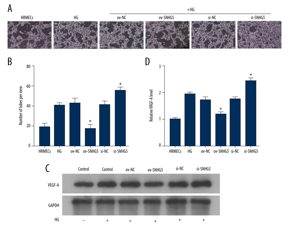SNHG5 reverses the effect of high glucose induction. Angiogenesis (A, B) was analyzed in each group, and western blotting (C, D) was performed to analyze the changes in VEGF-A protein levels. Transfection of ov-SNHG5 or si-SNHG5 was divided into the control group, HG group, HG+ov-NC group, HG+ov-SNHG5 group, HG+si-NC group, and HG+si-SNHG5 group. * P<0.05; HG – high glucose; NC – negative control; VEGF – vascular endothelial growth factor; HRMECs – Human Retinal Microvascular Endothelial Cells. Photoshop software (version 21.2.4; Adobe, Inc; San Jose, USA) was used for creation of the figure.